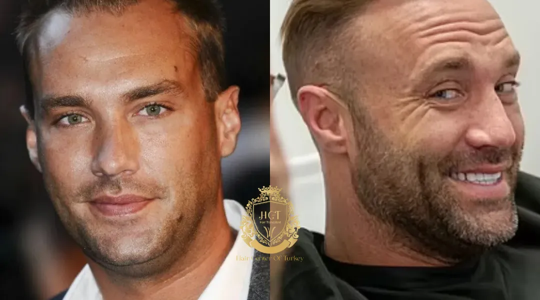 Calum Best Greffe de cheveux 1 Calum Best Haartransplantatie