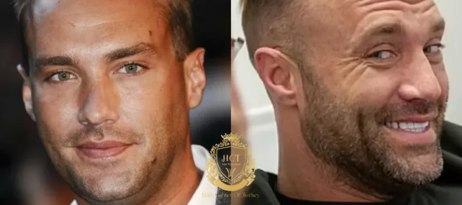 Calum Best Haartransplantation