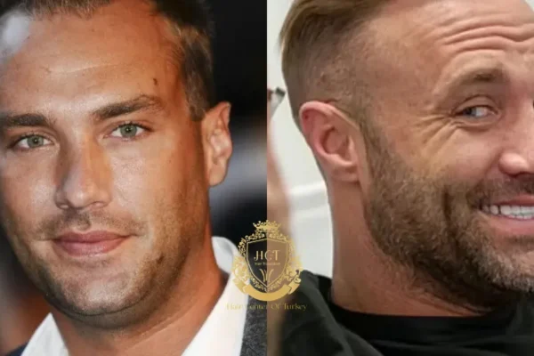 El Trasplante de Pelo de Calum Best