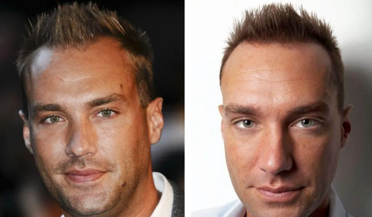 Calum Best Hair Transplant