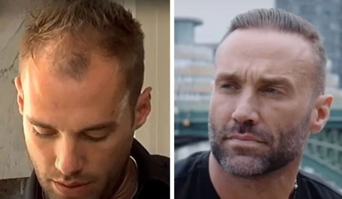 Calum Best Hair Transplant 8