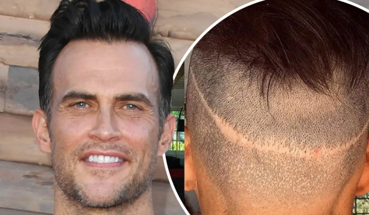 Cheyenne Jackson Hair Transplant