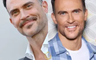 Cheyenne Jackson Hair Transplant