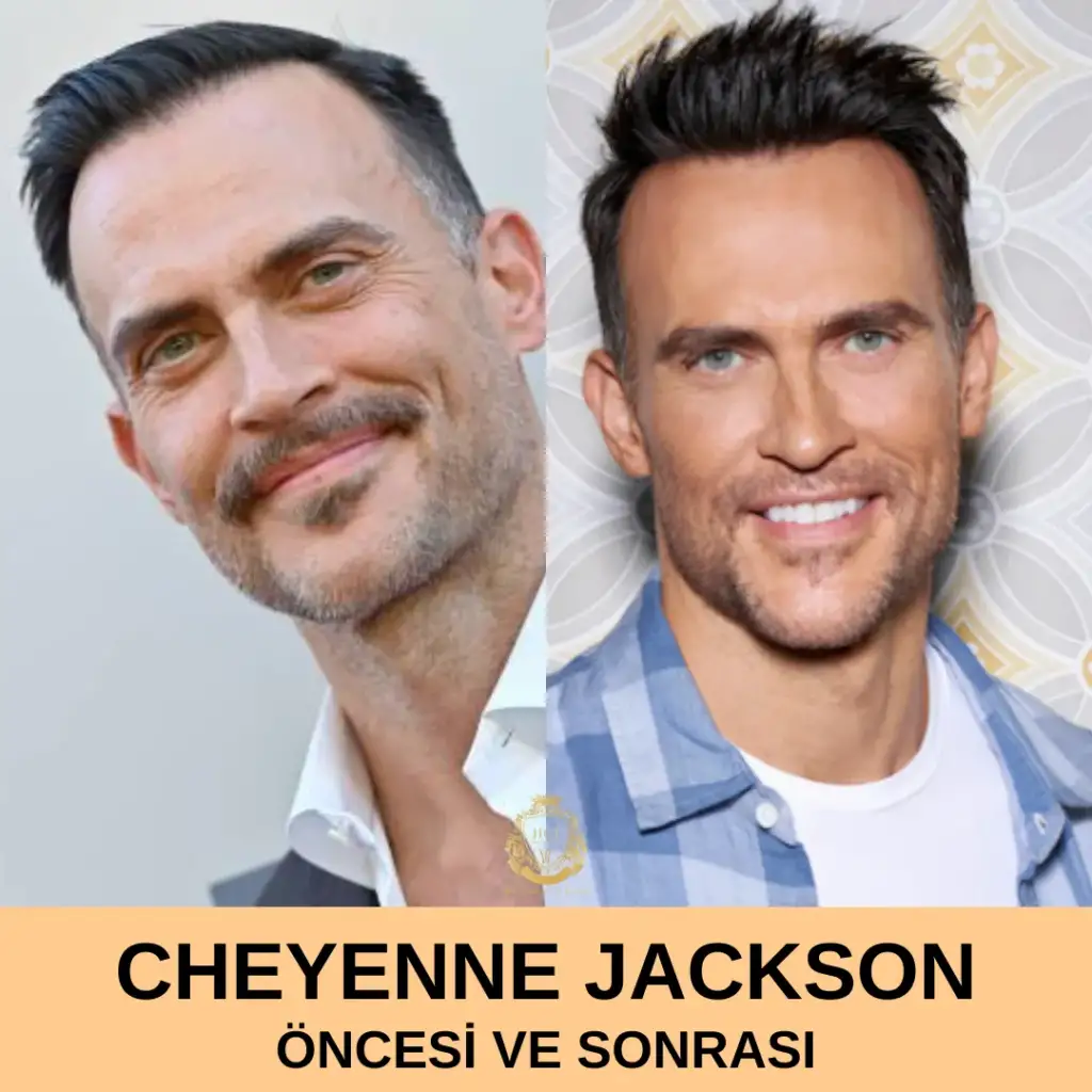 Cheyenne Jackson Hair Transplant