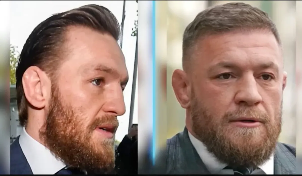 Conor Mcgregor Hair Transplant