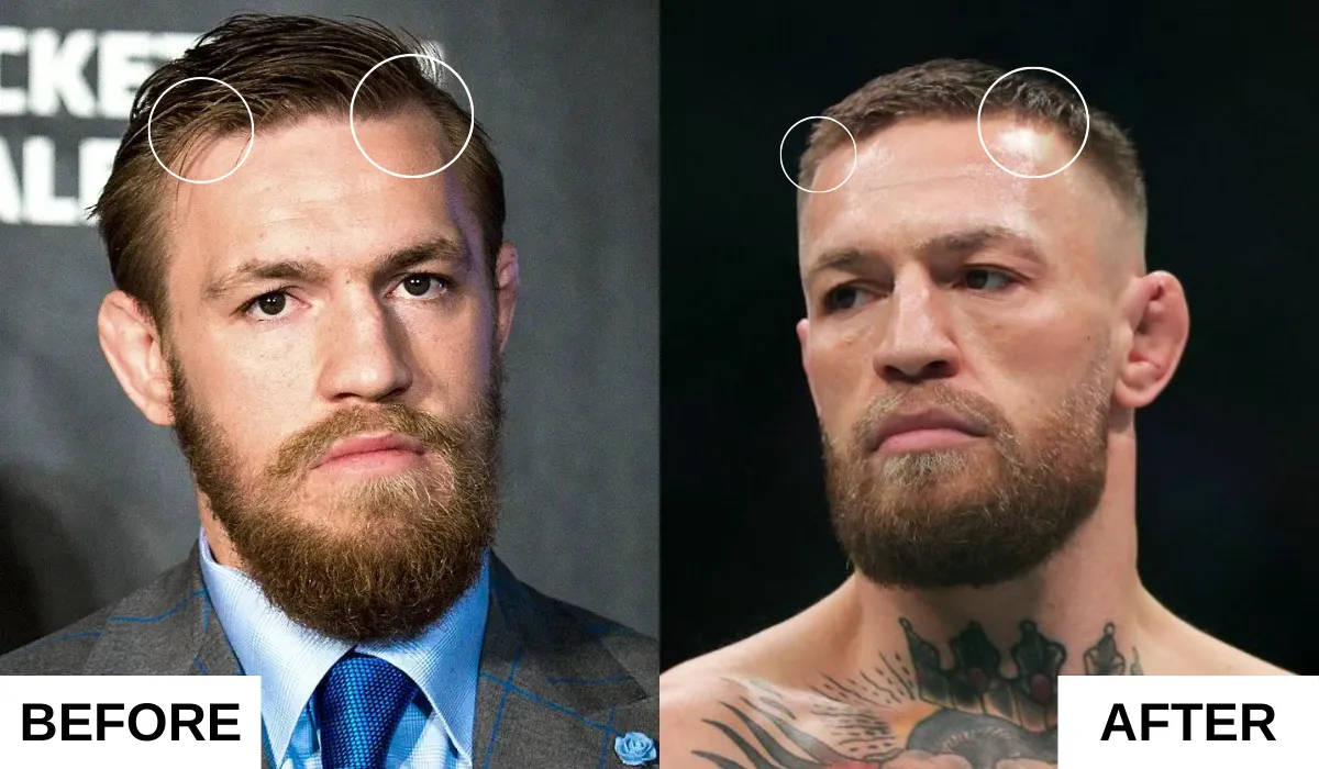 Conor Mcgregor Hair Transplant