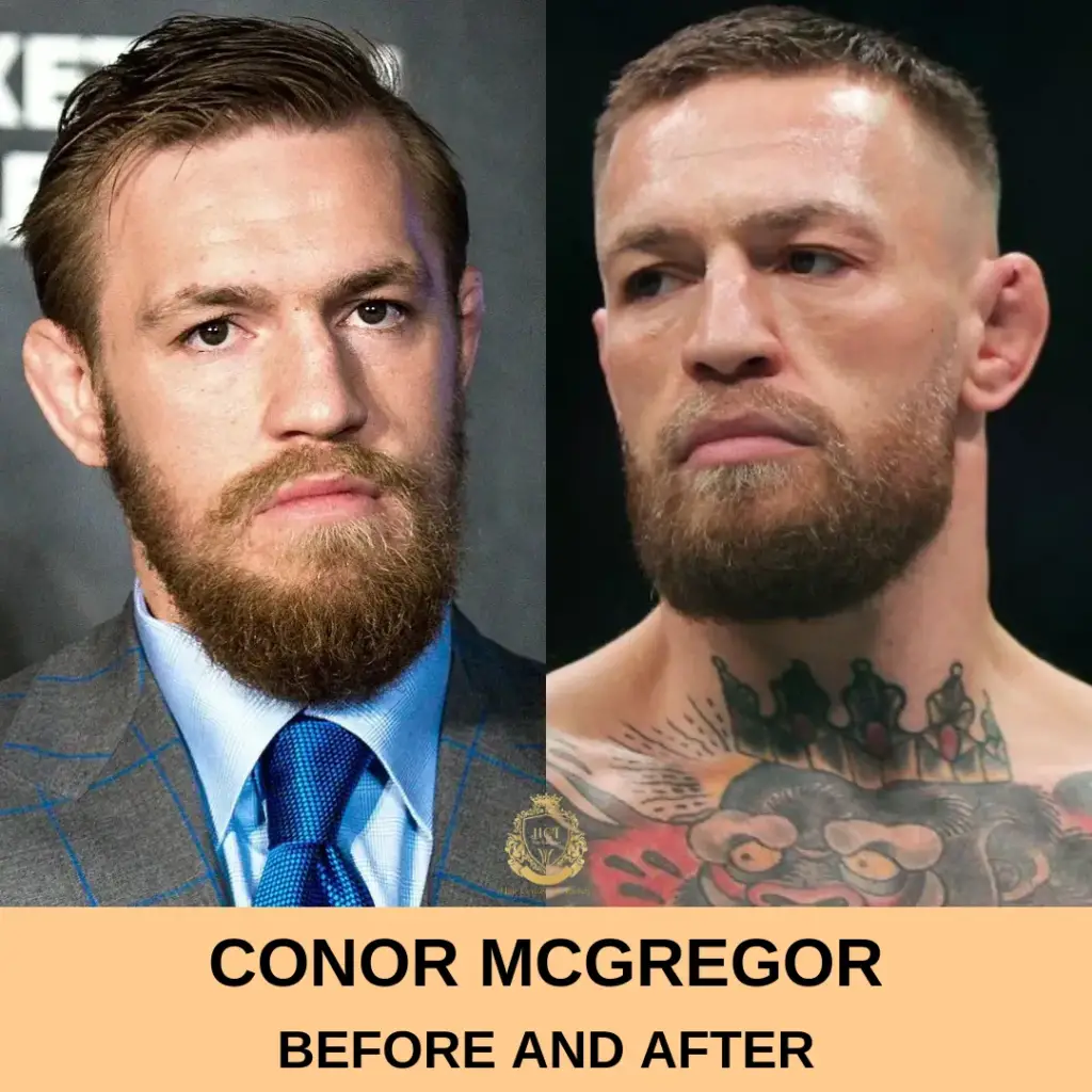 Conor Mcgregor Hair Transplant