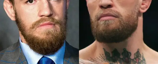 Conor Mcgregor Hair Transplant