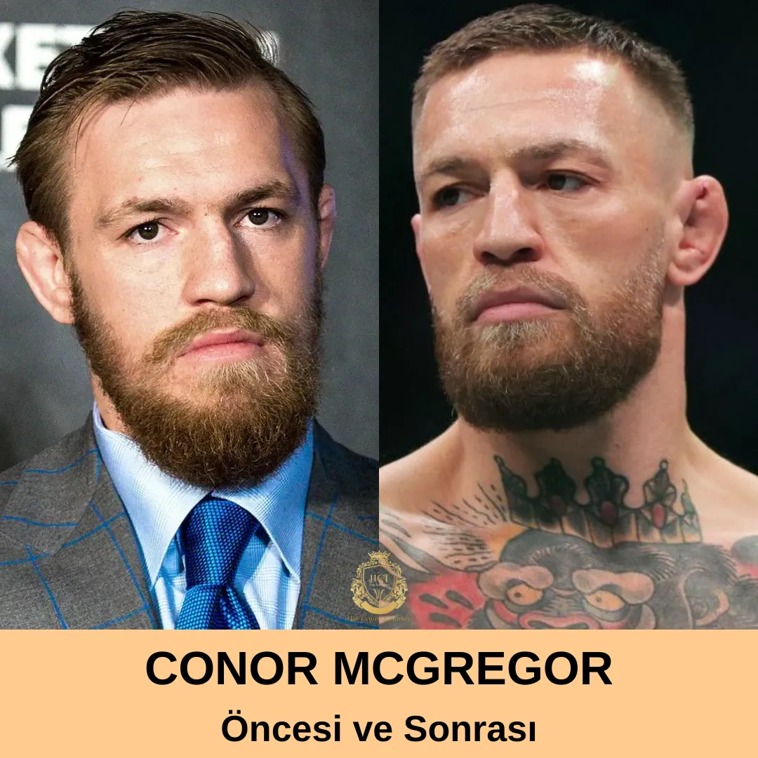 Conor Mcgregor Saç Ekimi