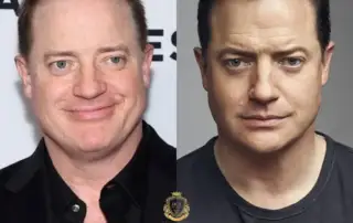 Brendan Fraser Hair Transplant