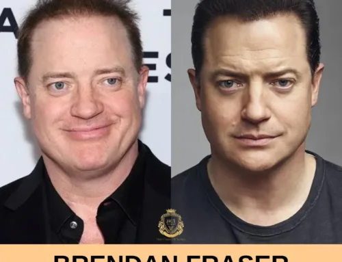 Brendan Fraser Haartransplantation