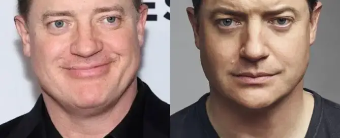 Brendan Fraser Hair Transplant