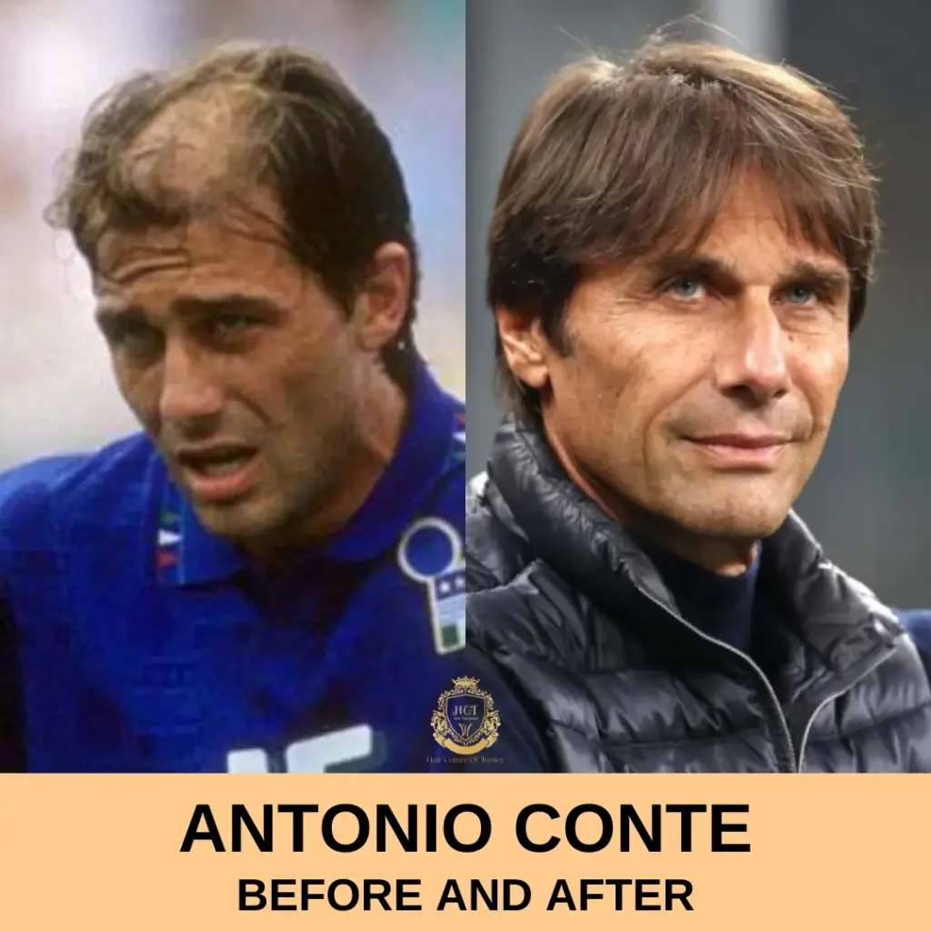 Antonio Conte Hair Transplant