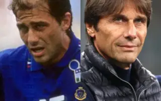 Antonio Conte Hair Transplant