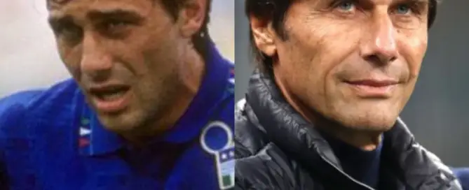 Antonio Conte Hair Transplant