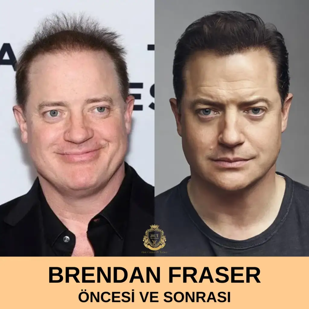 Brendan Fraser Hair Transplant