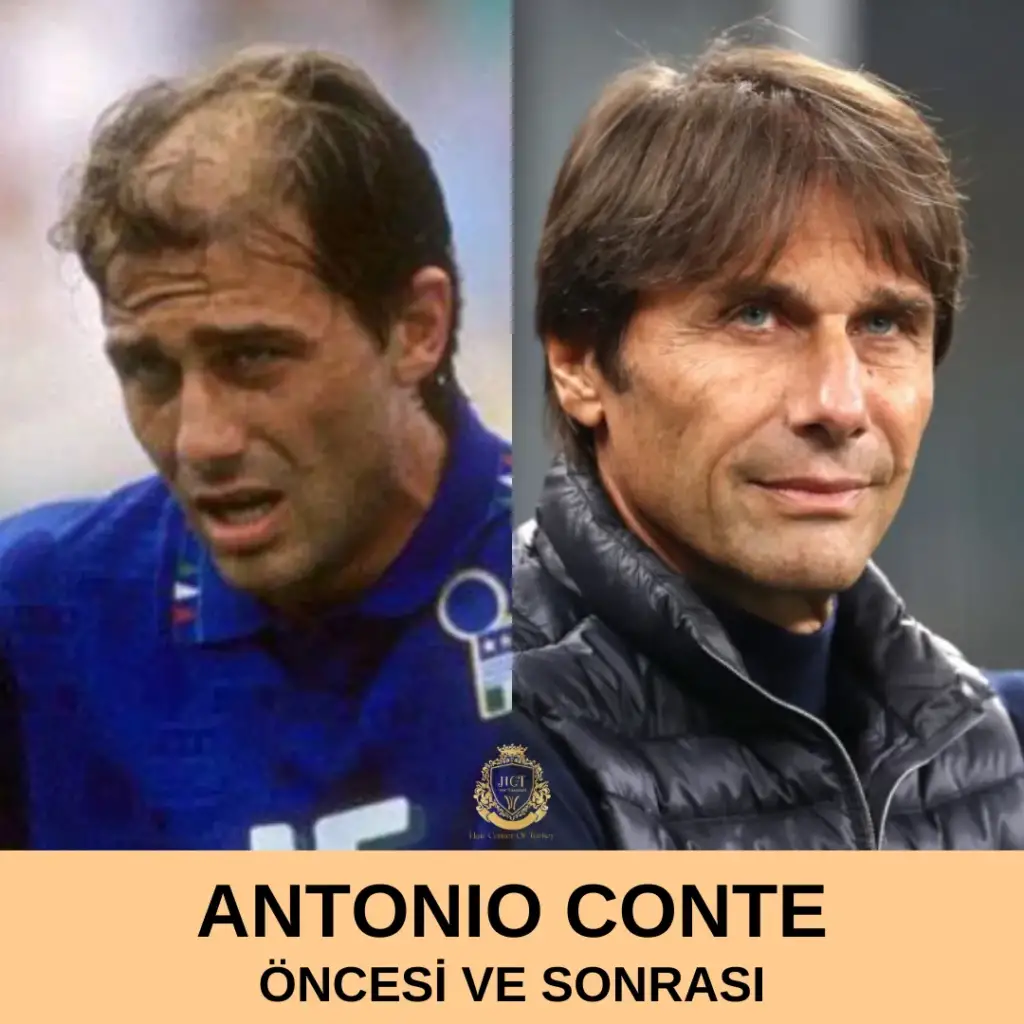 Antonio Conte Hair Transplant