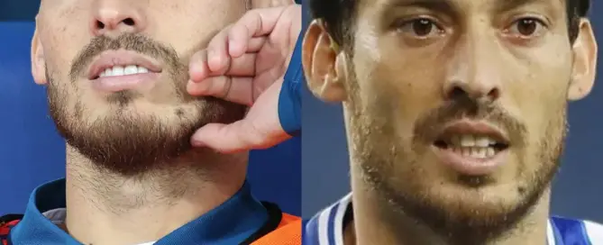 david silva Hair Transplant