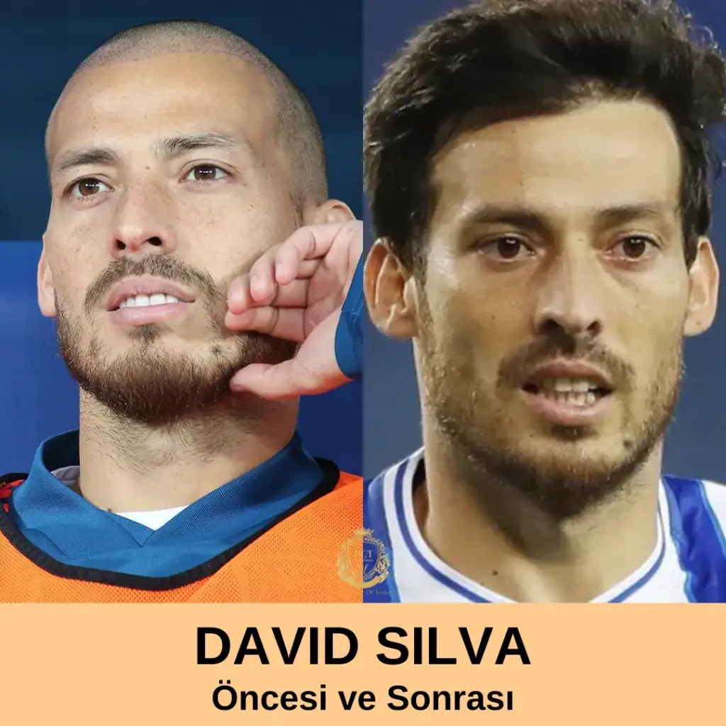 David Silva Saç Ekimi