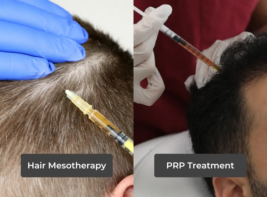 Differences Between Hair Mesotherapy and PRP