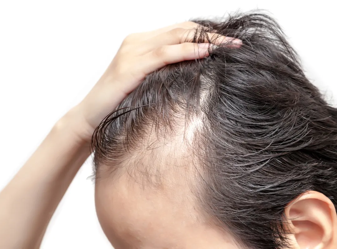 Does Hair Mesotherapy Promote Hair Growth 2