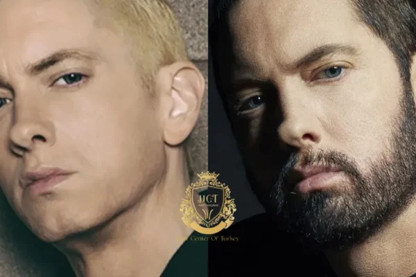 Eminem Hair Transplant