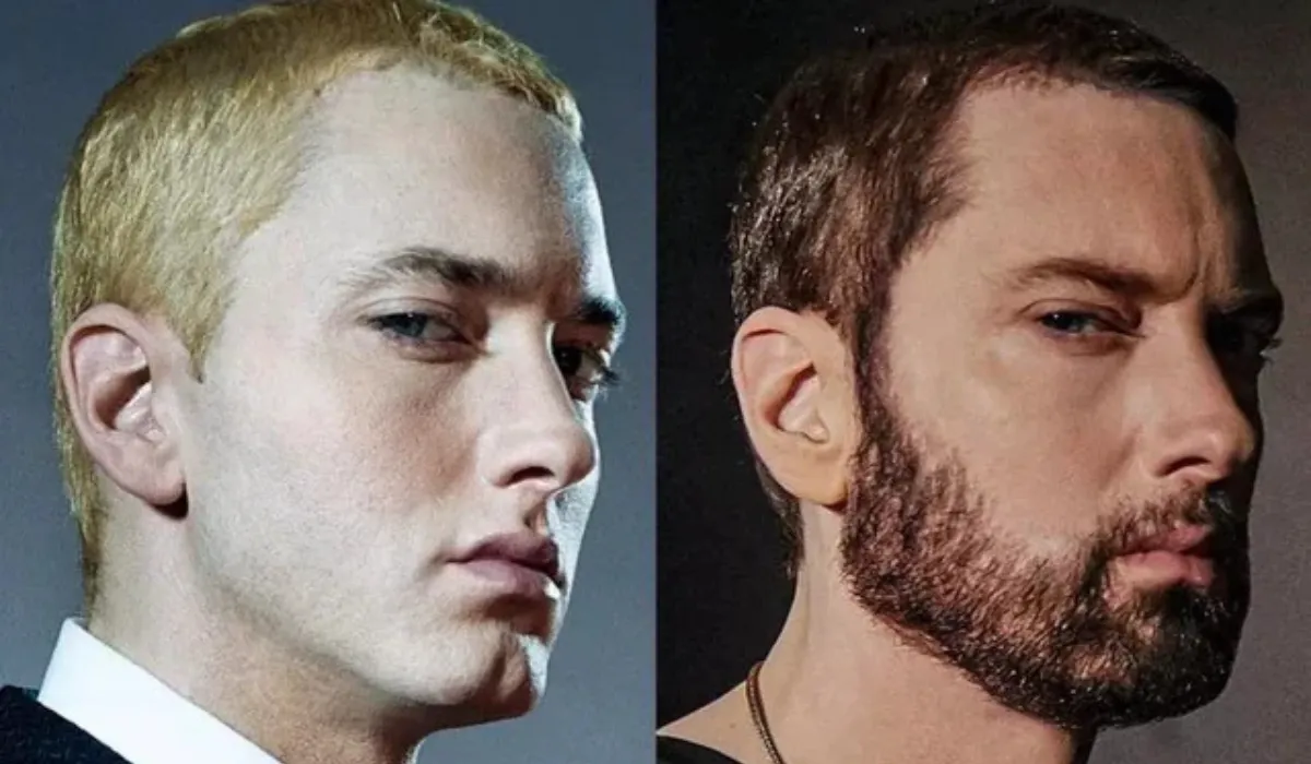 Eminem Hair Transplant