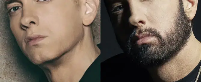 Eminem Hair Transplant