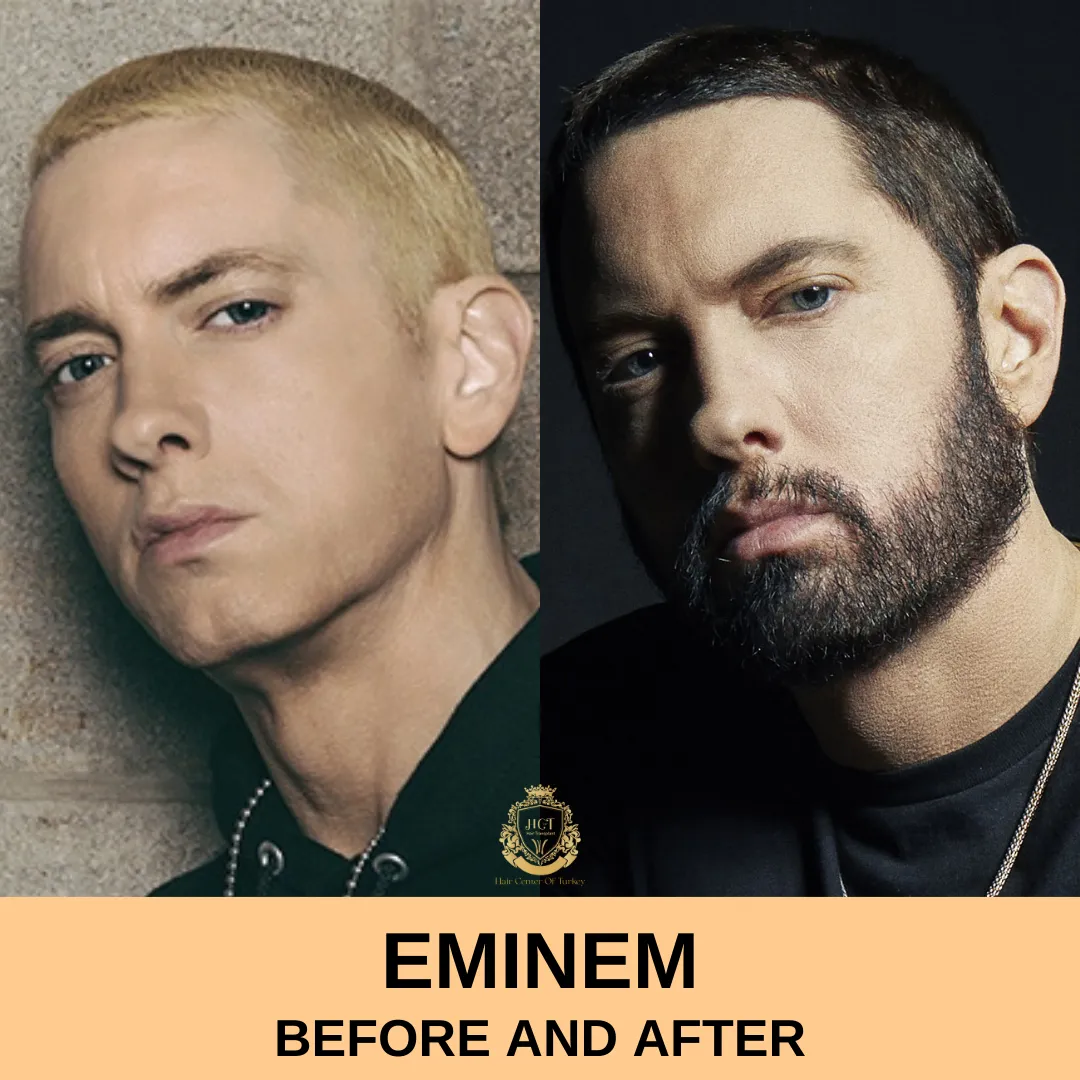 Eminem Hair Transplant