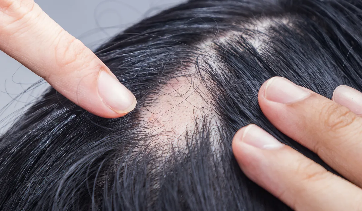 Emotional Stress on Hair Loss