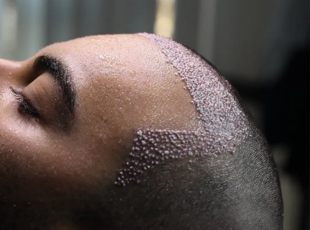 Hair Mesotherapy After Hair Transplant