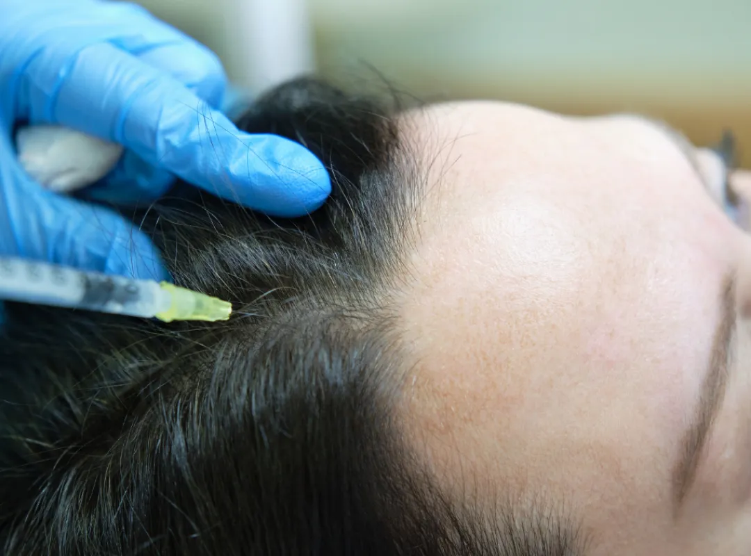 How is Hair Mesotherapy Applied