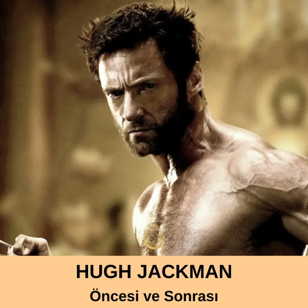 Hugh Jackman Saç Ekimi