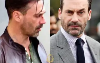 Jon Hamm Hair Transplant