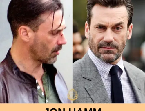 Jon Hamm Haartransplantation