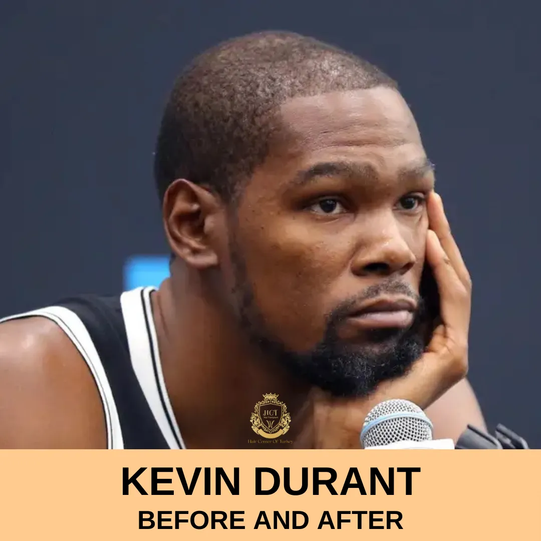 Kevin Durant Hair Transplant