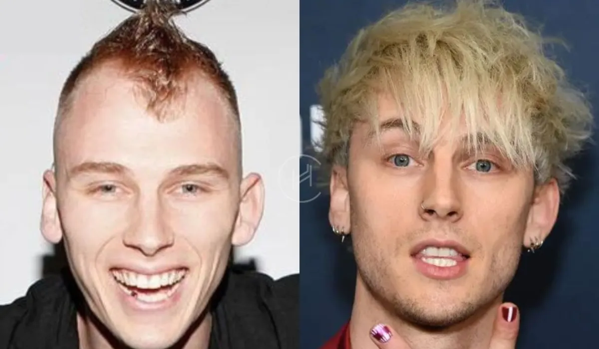 MGK Hair Transplant