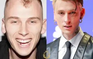 MGK Hair Transplant