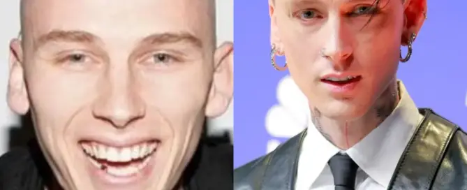 MGK Hair Transplant