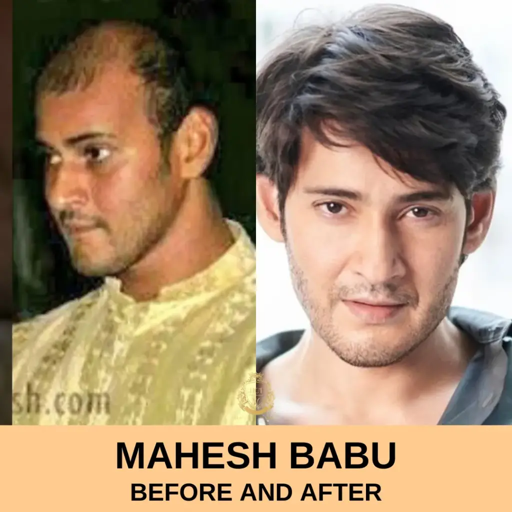 mahesh babu Hair Transplant