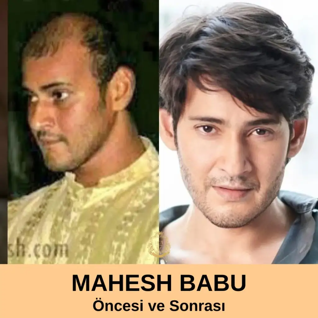 Mahesh Babu Saç Ekimi