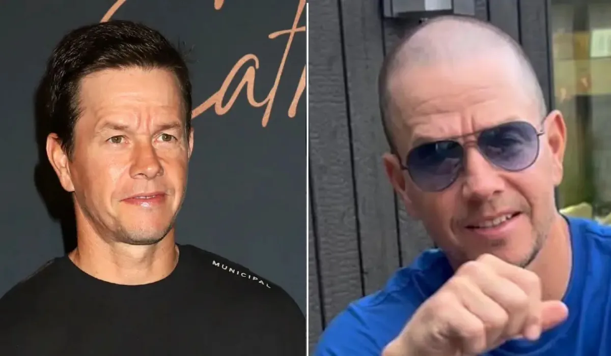 Mark Wahlberg Hair Transplant