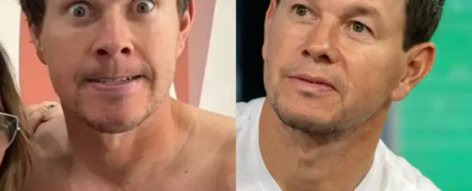 Mark Wahlberg Hair Transplant