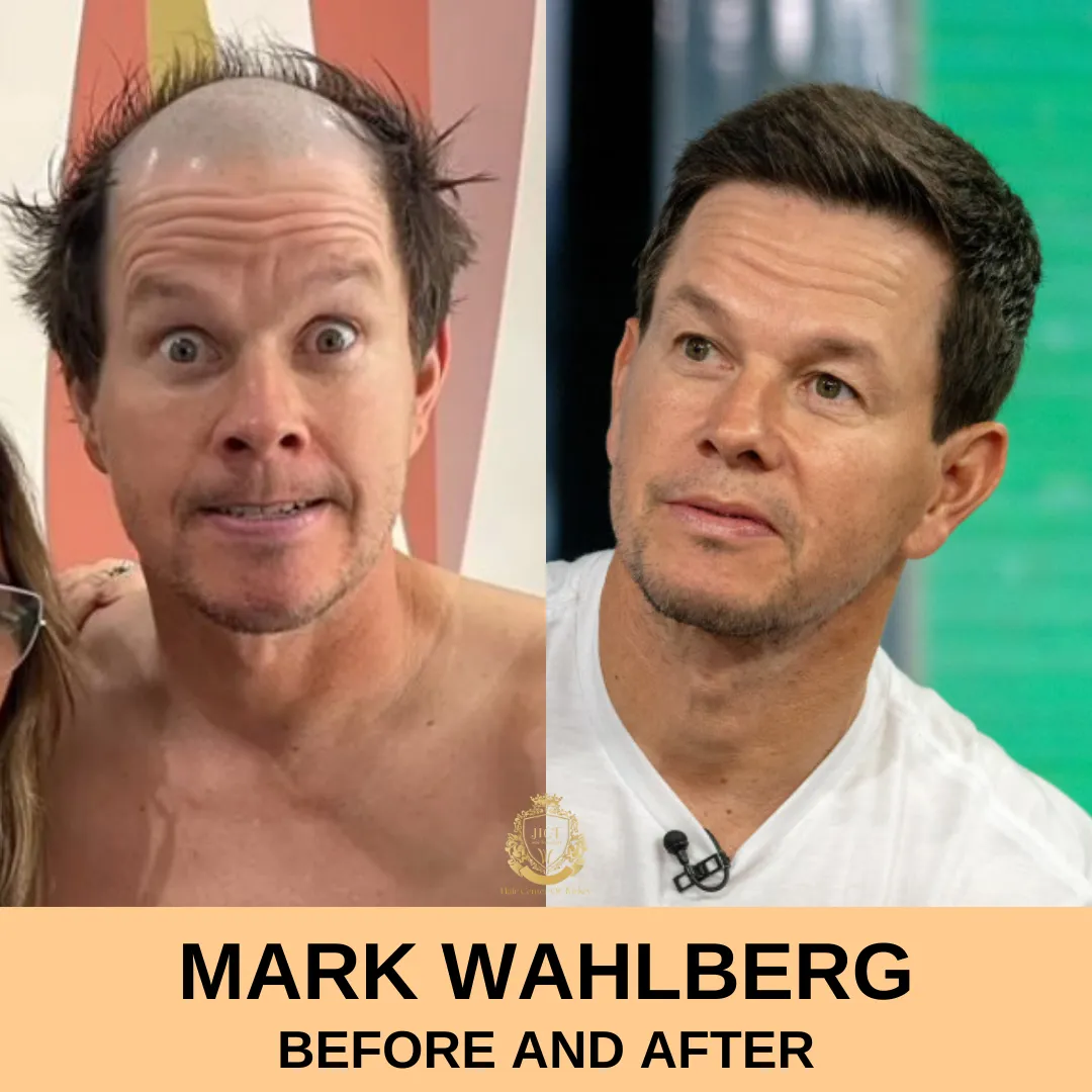 Mark Wahlberg Hair Transplant