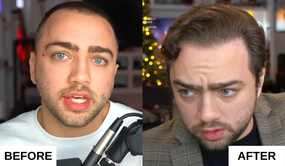 Mizkif Hair Transplant