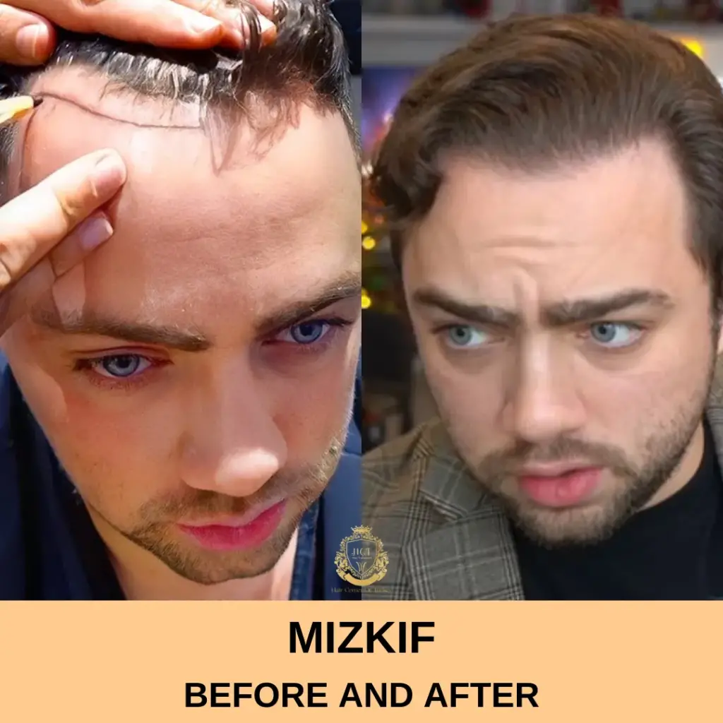 Mizkif Hair Transplant