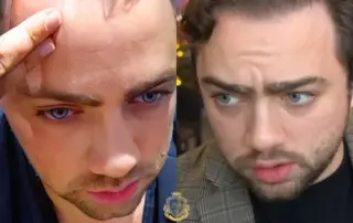 Mizkif Hair Transplant