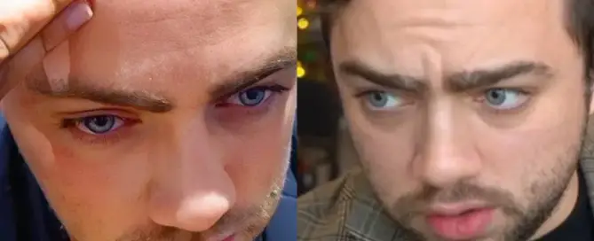 Mizkif Hair Transplant