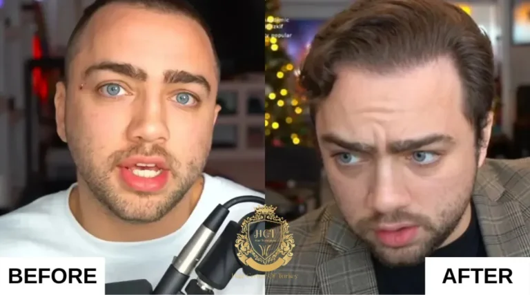 Mizkif (Matthew Rinaudo) Transplante capilar