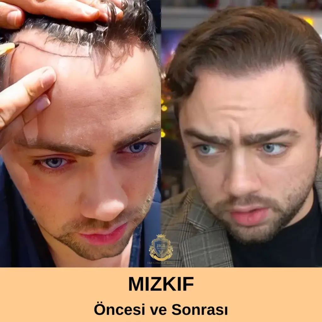 Mizkif Saç Ekimi